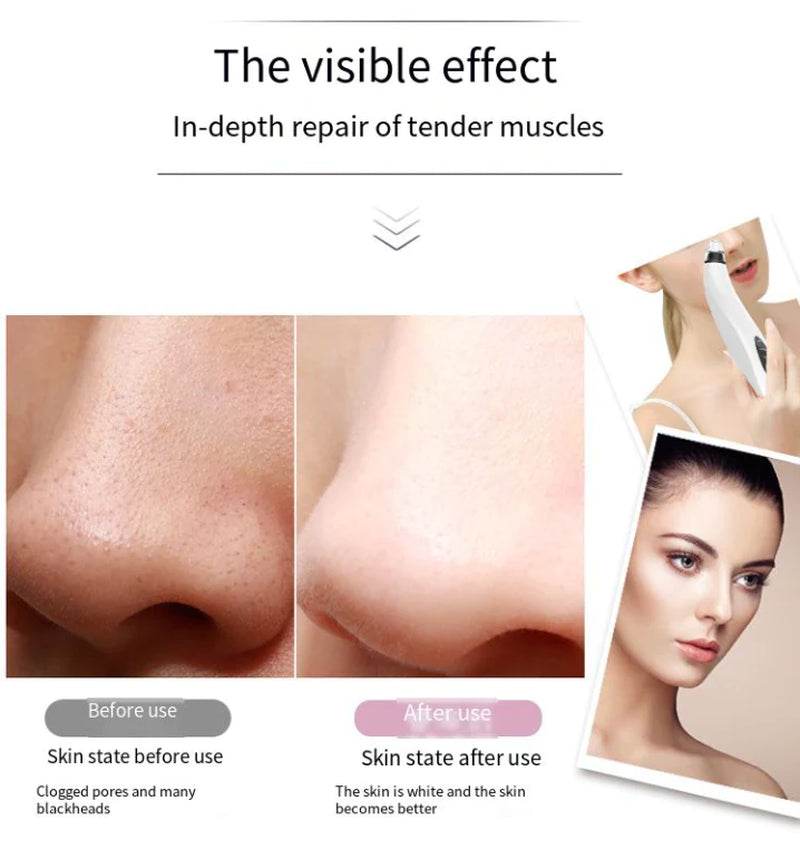 Electric Blackhead Remover Cleaner Face Diamond Pore Vacuum Suction White Heads - My Store